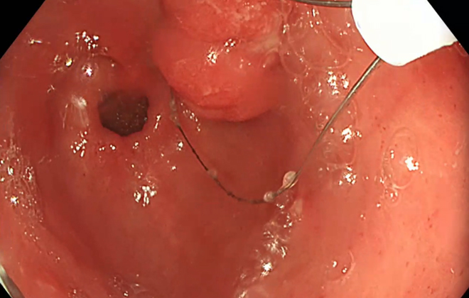 Additional Working Channel Solution with Minimally Invasive Surgical Instruments