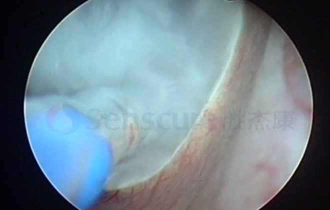 Bladder Tumor Cryoablation Solution with Minimally Invasive Surgical Instruments