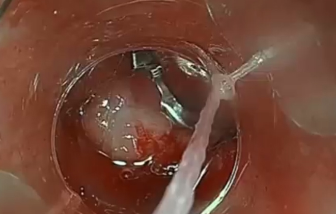 Endoscopic Closure/Hemostasis Solution with Minimally Invasive Surgical Instruments