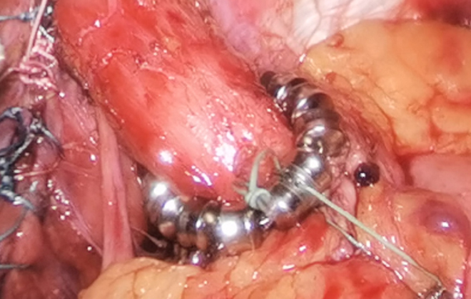 GERD Treatment Solution with Minimally Invasive Surgical Instruments