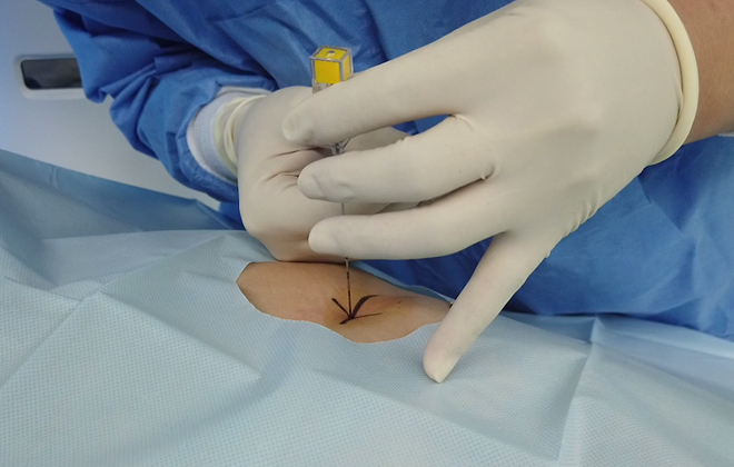 Pulmonary Nodules Localization Solution with Minimally Invasive Surgical Instruments