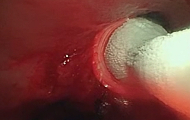 Respiratory Cryoablation Solutions with Minimally Invasive Surgical Instruments
