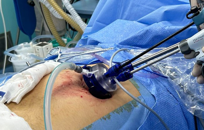 Single-Port Laparoscopic Surgery Solution with Minimally Invasive Surgical Instruments
