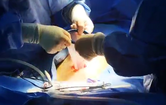 Surgical Access & Wound Protection Solution with Minimally Invasive Surgical Instruments