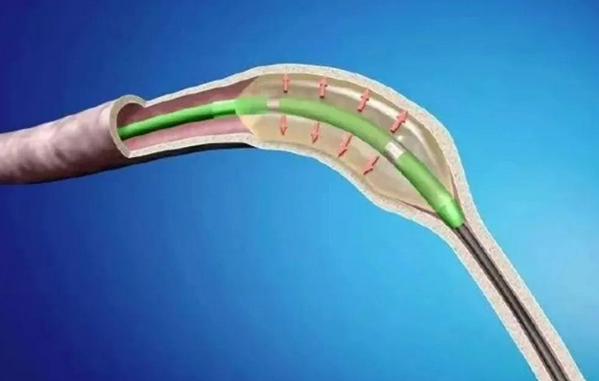 Ureteral Stenosis Dilation Solution with Minimally Invasive Surgical Instruments