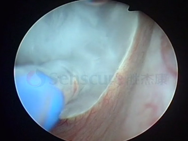 Bladder Tumor Cryoablation Solution