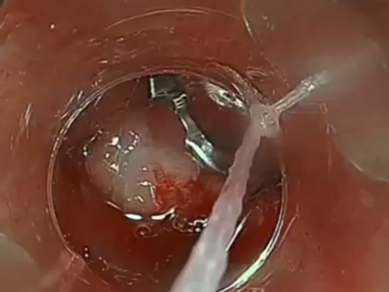 Endoscopic Closure/Hemostasis Solution