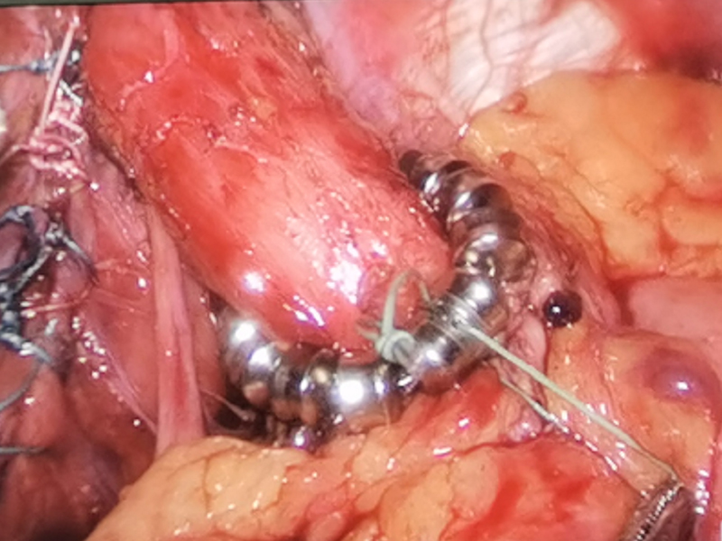 GERD Treatment Solution