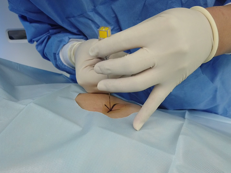 Pulmonary Nodules Localization Solution