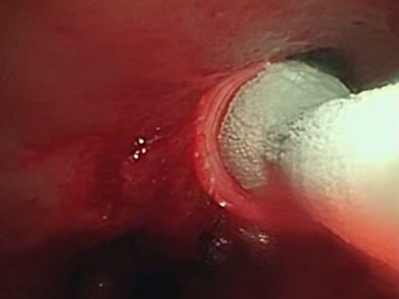 Respiratory Cryoablation Solutions