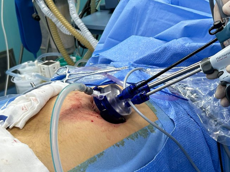 Single-Port Laparoscopic Surgery Solution
