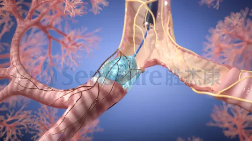 conference flash senscure pulmonary vagal nerve cryoablation cb tld surgically live streamed at shanghai east hospital conference flash senscure pulmonary vagal nerve cryoablation cb tld surgically live streamed at shanghai east hospital