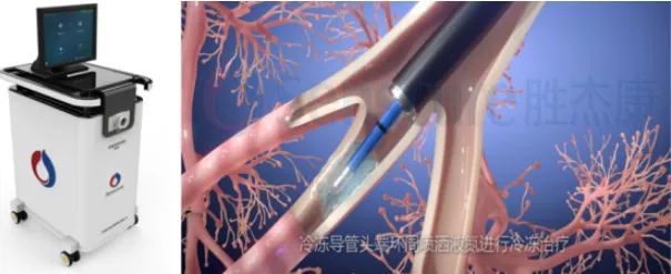 good news first patient enrolled in pivotal clinical trial of spray cryoablation system for copd treatment good news first patient enrolled in pivotal clinical trial of spray cryoablation system for copd treatment