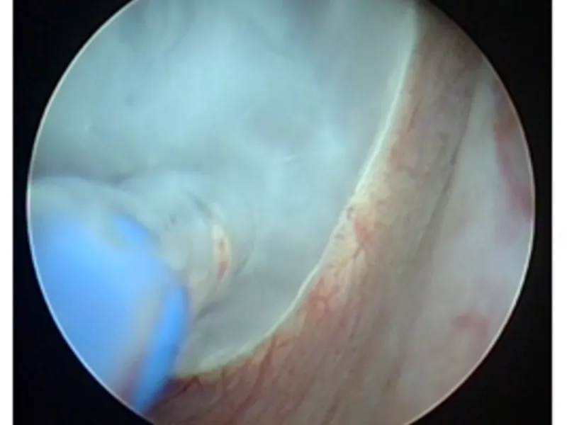 Bladder Tumor Cryoablation Solution
