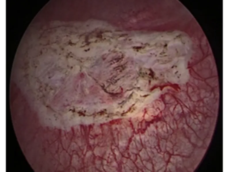 Bladder Tumor Cryoablation Solution
