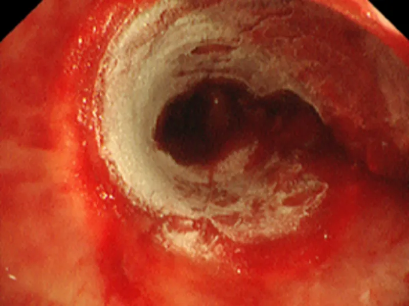 Clinical Pain Points Thermal Ablation