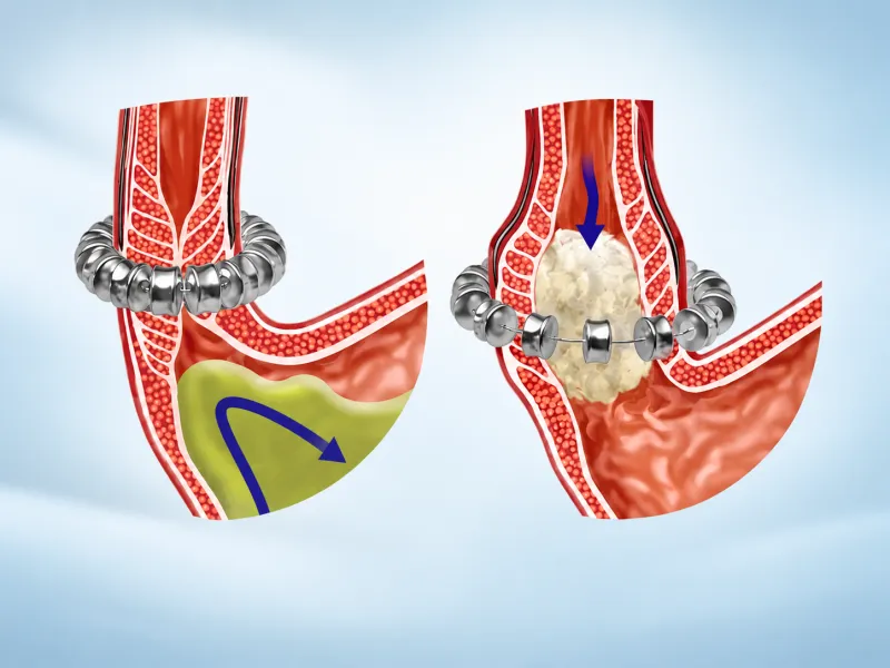 GERD Treatment Solution Clinical Solutions