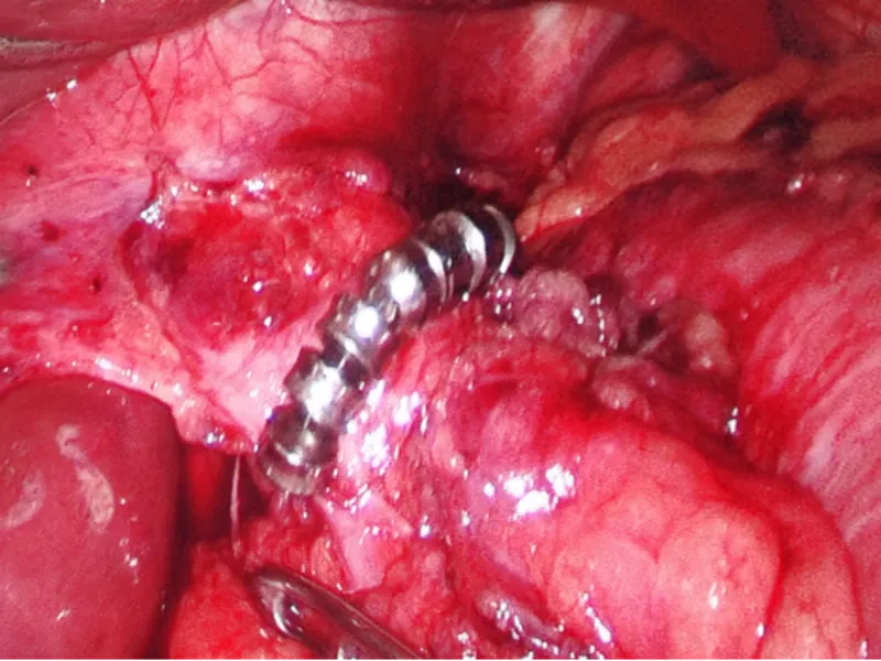 GERD Treatment Solution Core Advantages