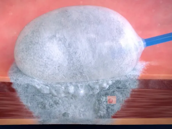 Key Benefits of Bladder Tumor Cryoablation System