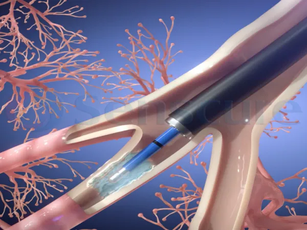 Key Benefits of Respiratory Cryoablation System