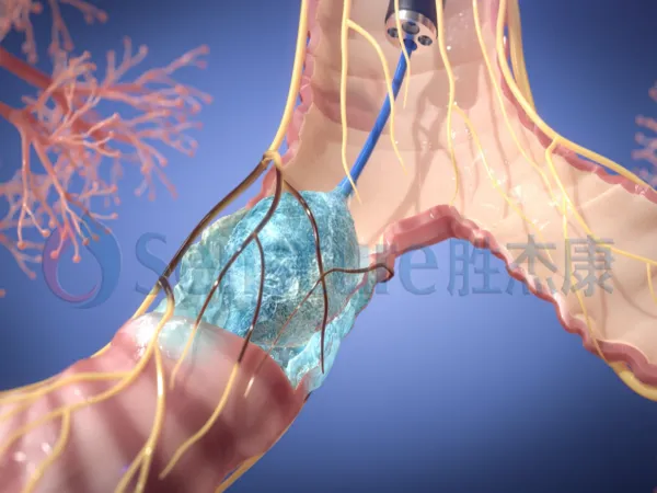 Key Benefits of Respiratory Cryoablation System