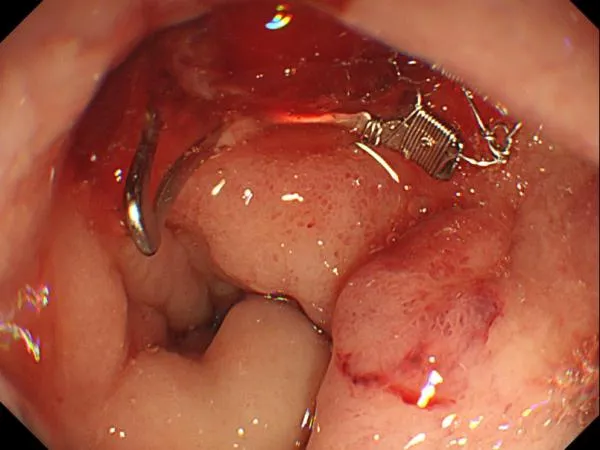Hemostasis Solution Clinical Pain Points