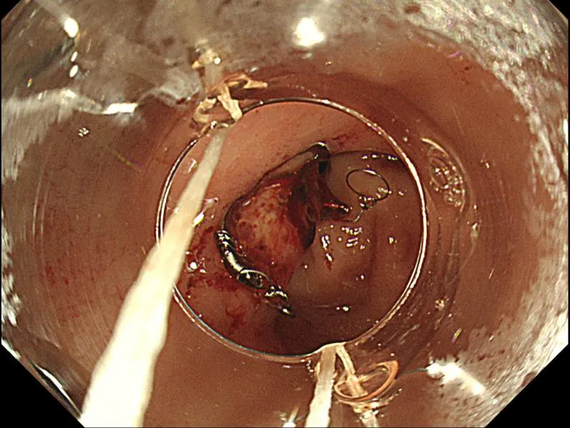 Hemostasis Solution Core Advantages