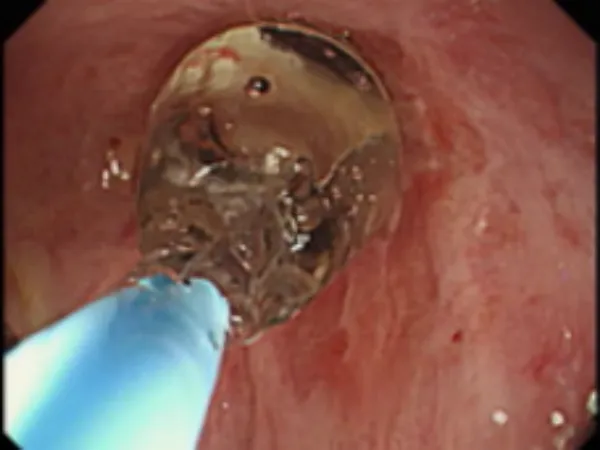 GI Stenosis Dilation Solution