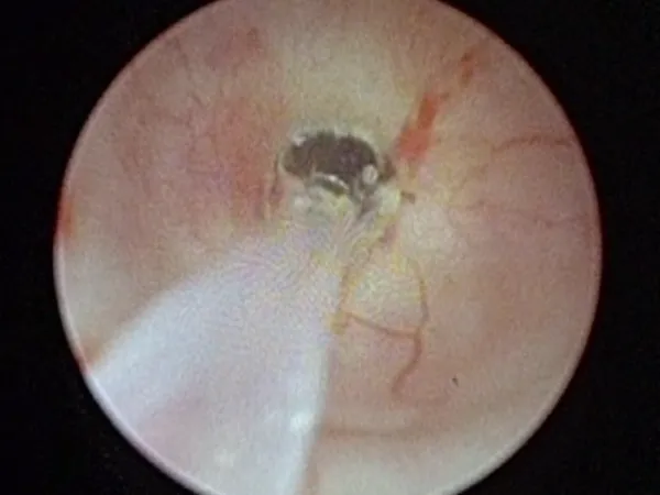 Ureteral Stenosis Dilation Solution