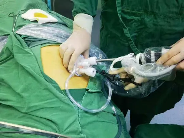 Key Benefits of Silicone Multi-instrument Laparoscopic Access Platform