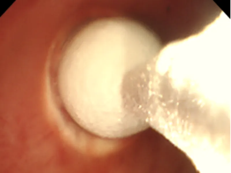 Addressing Mechanical Resection Pain Points