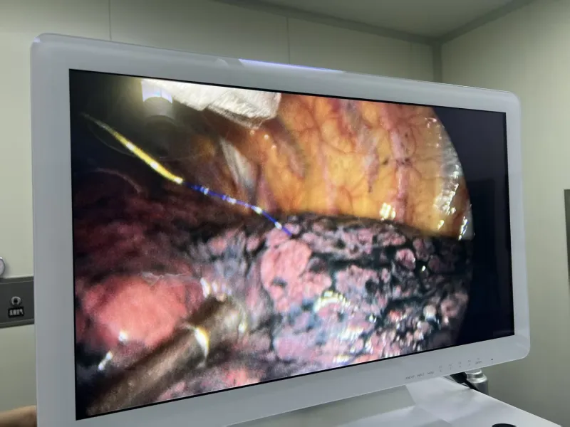 Pulmonary Nodules Localization Solution Clinical Value