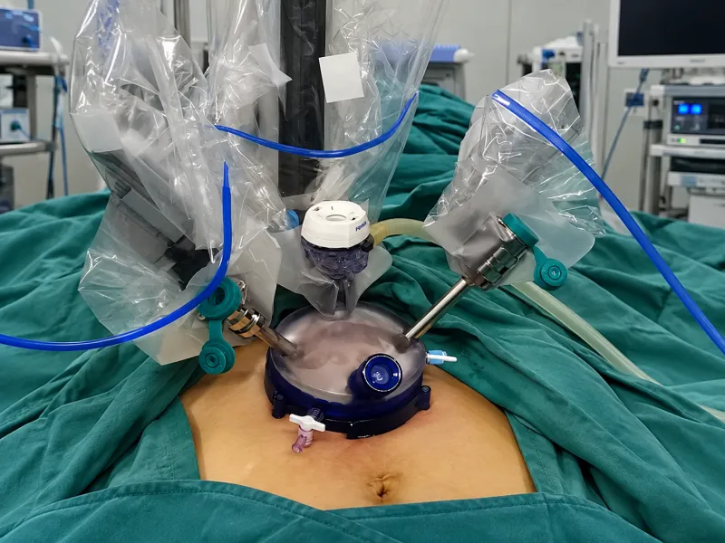 Single-Port Laparoscopic Surgery Solution Core Advantage