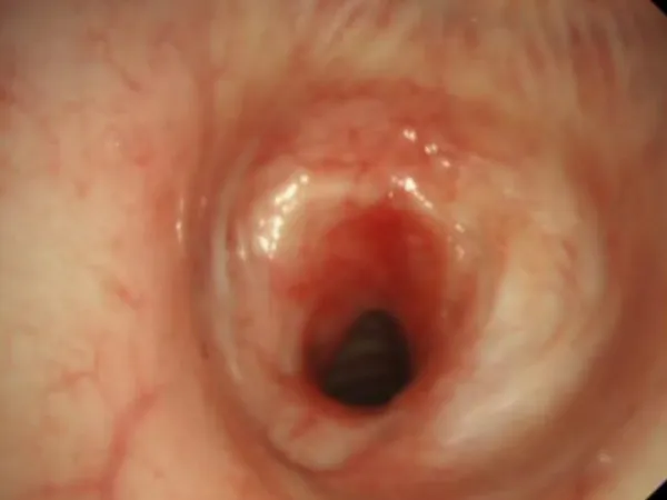 Airway Stenosis Dilation Solution