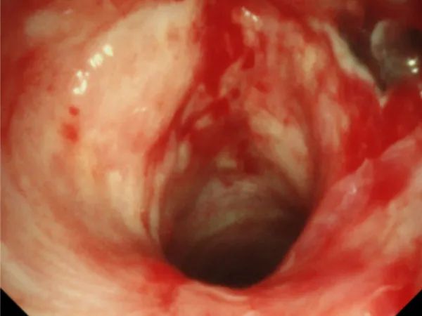 Airway Stenosis Dilation Solution