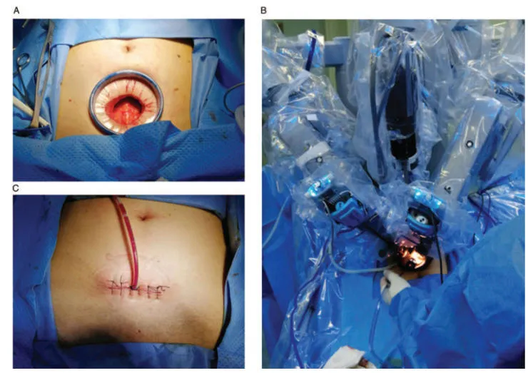 Extraperitoneal Single-Port Robotic-Assisted Radical Prostatectomy.jpg